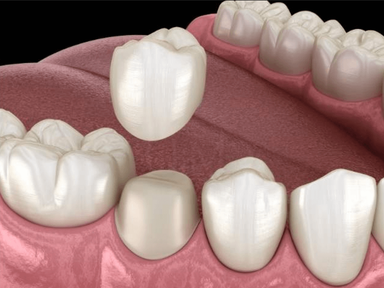 Dental crown. Zirconia crown & Metal-ceramic or PFM