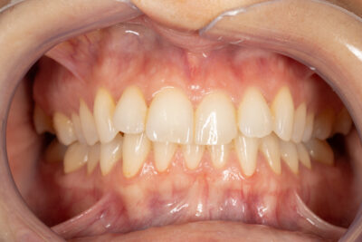 Струпани зъби преди ортодонтско лечение с Invisalign във Варна