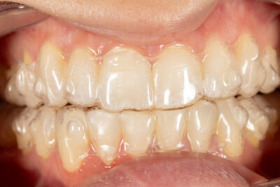 Прозрачни алайнери Invisalign по време на ортодонтско лечение във Варна